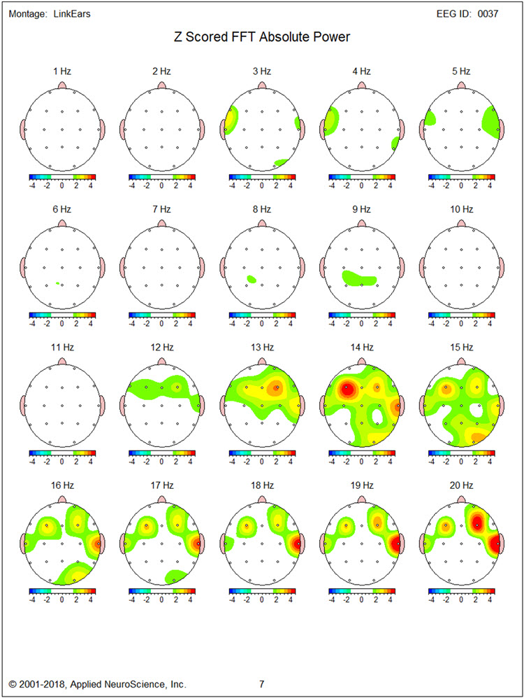 Figure 10 - Baseline eyes-open z-score FFT absolute power single-Hz bins 1-20 Hz